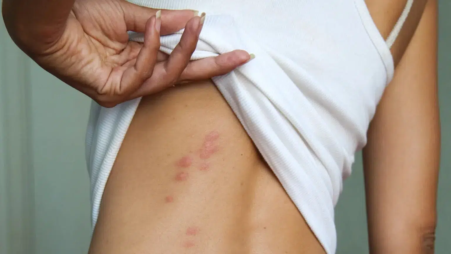 Piqûres groupées de punaises de lit sur le dos - symptômes typiques d'infestation